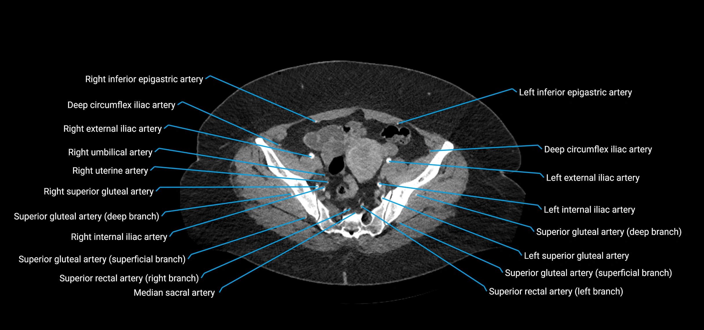 CTA abdomen axial cross sectional anatomy labelled image_206 (2).webp